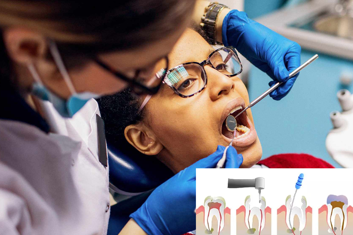 Root-canal1