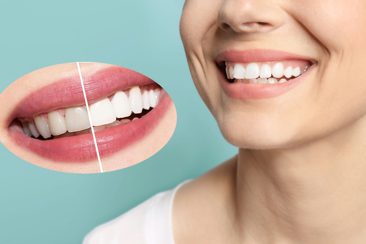 teeth-whitening